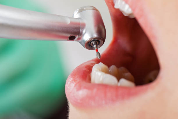 Best Emergency Dental Extractions in Hyrum, UT